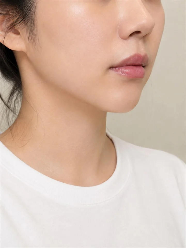 女性下顎線拉提療程後的範例照片