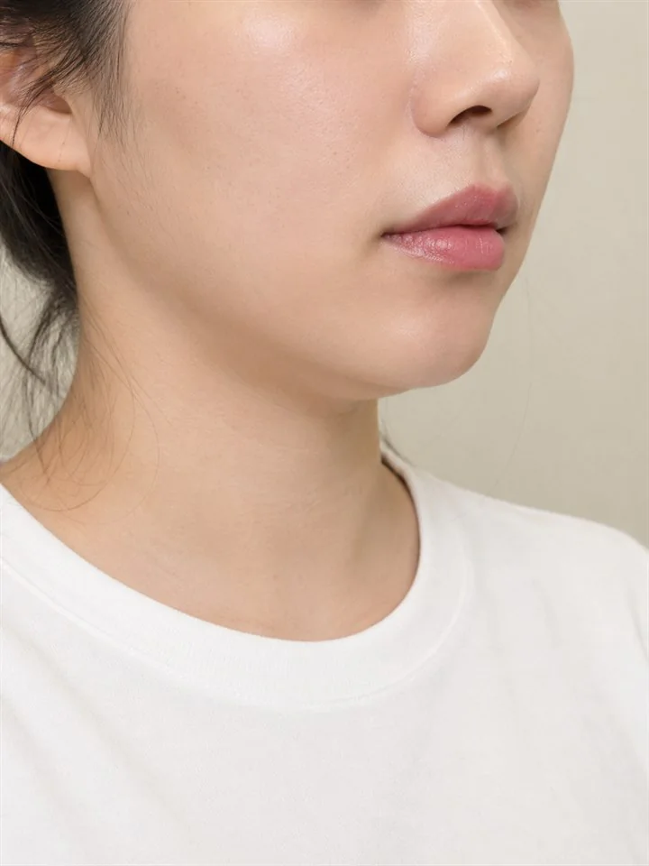 女性下顎線拉提療程前的範例照片